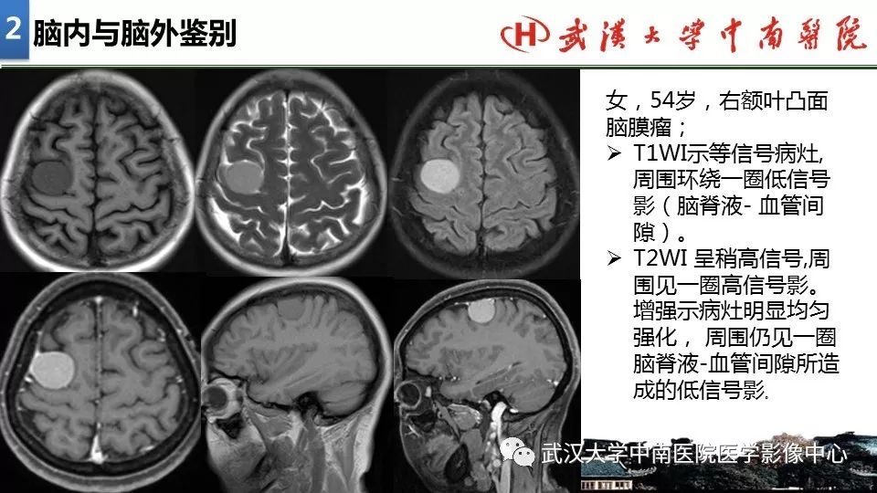 影像PPT - 【PPT】局灶性脑部病变影像诊断-12