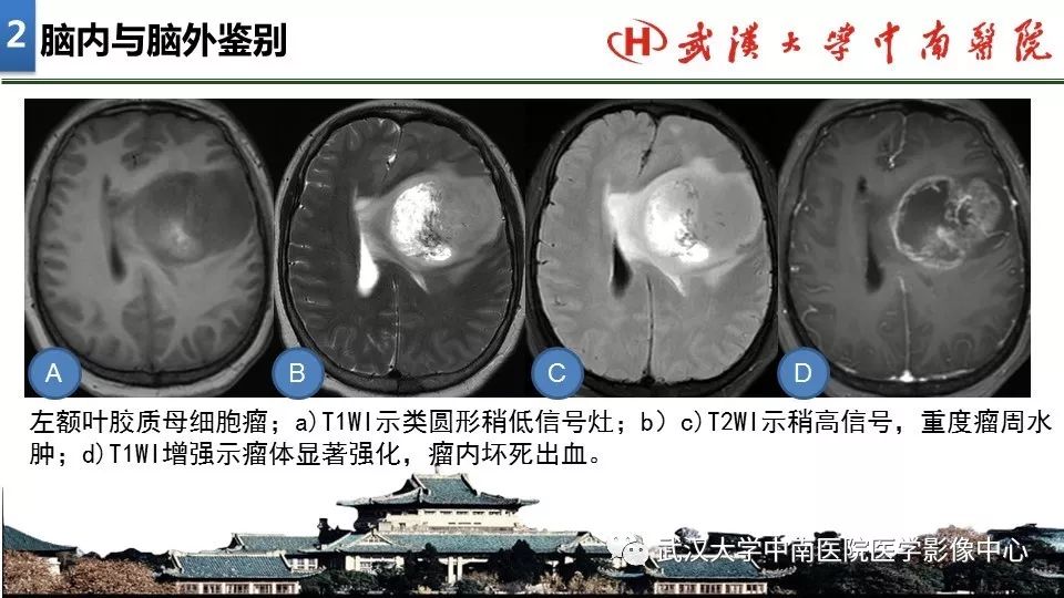 影像PPT - 【PPT】局灶性脑部病变影像诊断-13