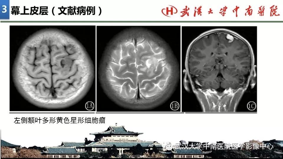 影像PPT - 【PPT】局灶性脑部病变影像诊断-15
