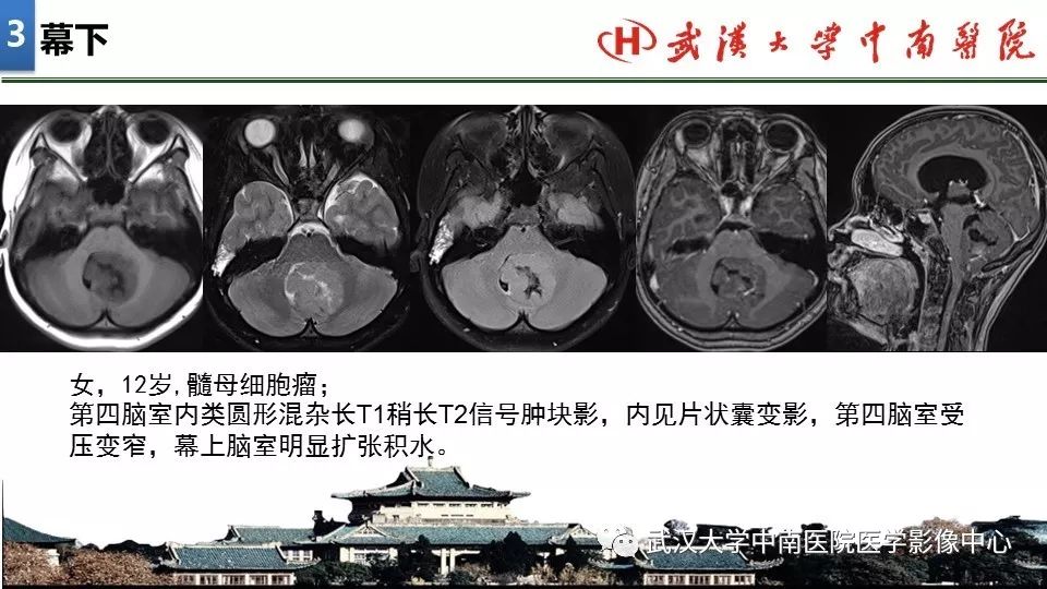影像PPT - 【PPT】局灶性脑部病变影像诊断-16