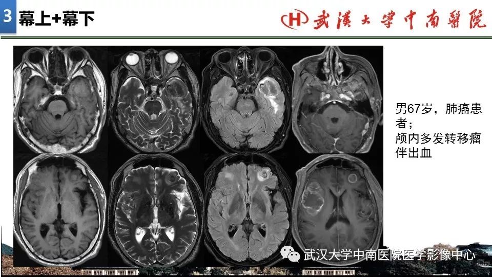 影像PPT - 【PPT】局灶性脑部病变影像诊断-17