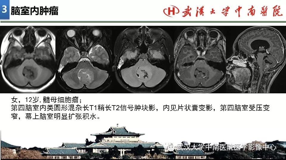 影像PPT - 【PPT】局灶性脑部病变影像诊断-20