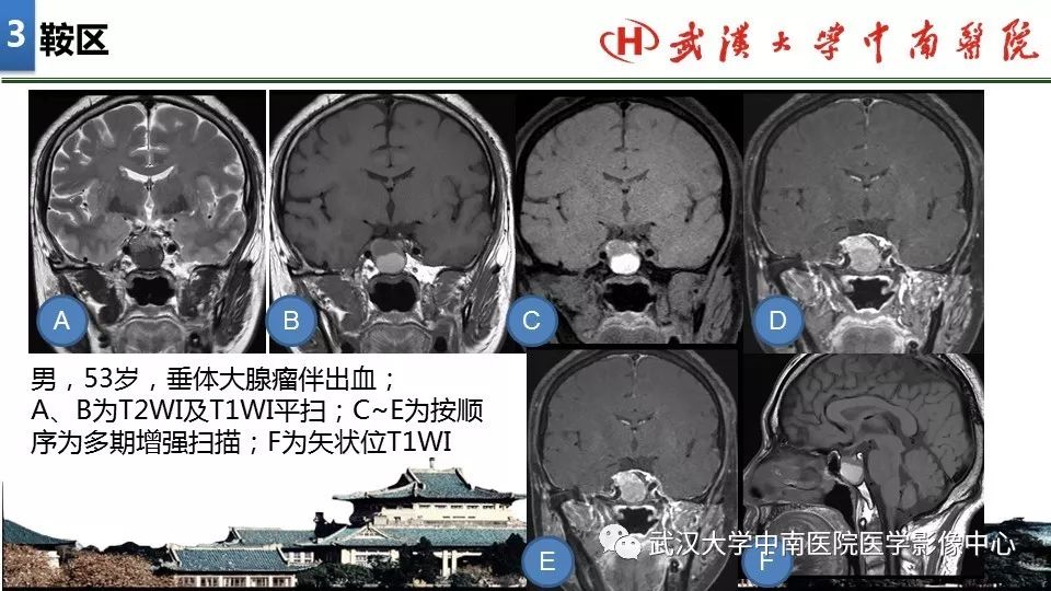 影像PPT - 【PPT】局灶性脑部病变影像诊断-21