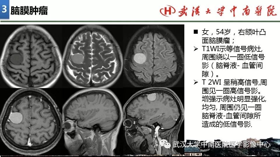 影像PPT - 【PPT】局灶性脑部病变影像诊断-22