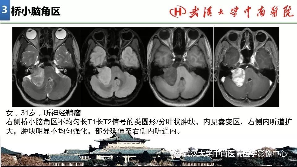 影像PPT - 【PPT】局灶性脑部病变影像诊断-24
