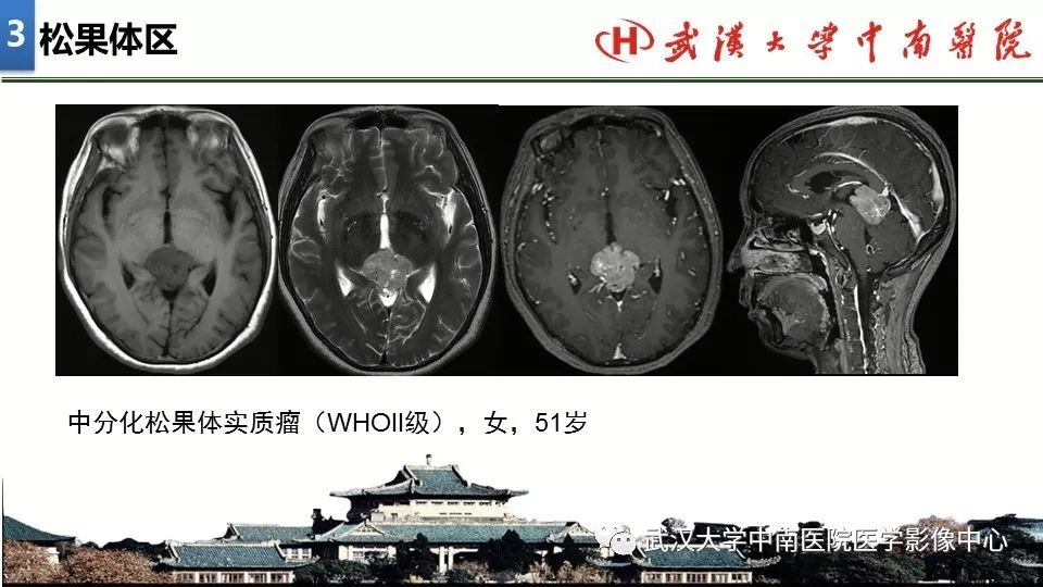 影像PPT - 【PPT】局灶性脑部病变影像诊断-25