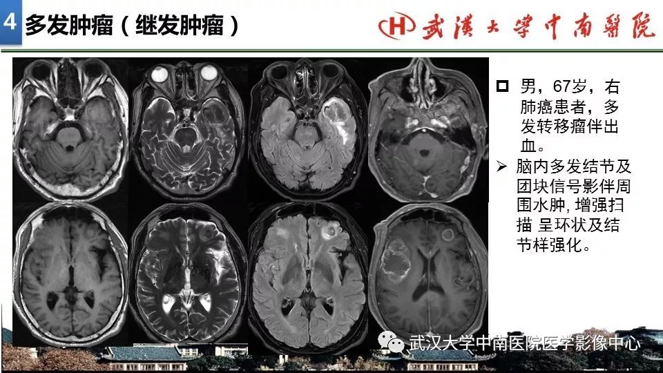 影像PPT - 【PPT】局灶性脑部病变影像诊断-28