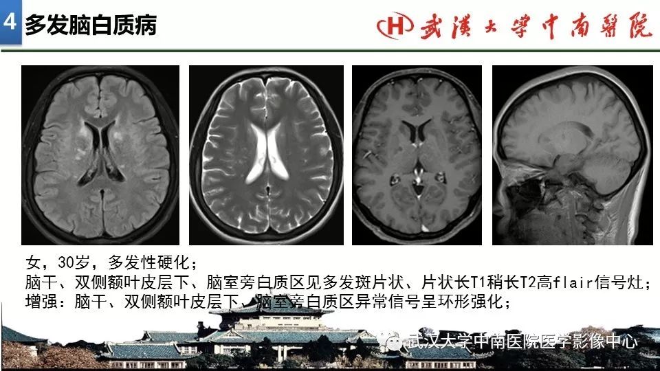 影像PPT - 【PPT】局灶性脑部病变影像诊断-30