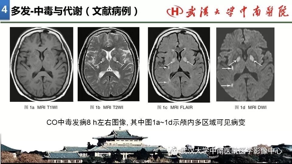 影像PPT - 【PPT】局灶性脑部病变影像诊断-31