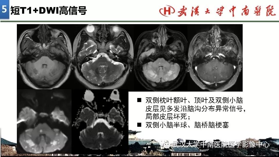 影像PPT - 【PPT】局灶性脑部病变影像诊断-33
