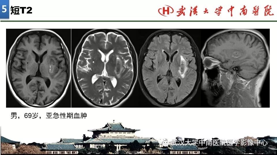 影像PPT - 【PPT】局灶性脑部病变影像诊断-35
