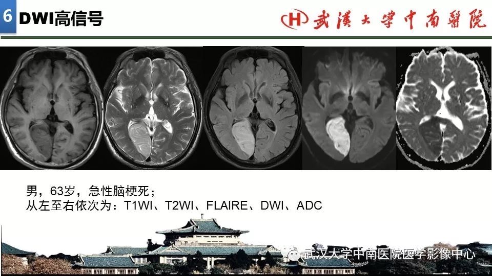 影像PPT - 【PPT】局灶性脑部病变影像诊断-38