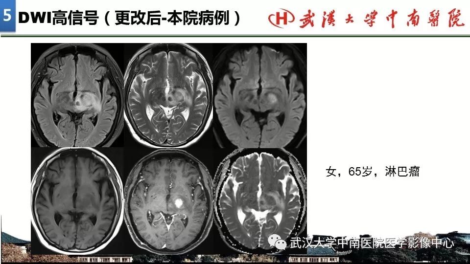 影像PPT - 【PPT】局灶性脑部病变影像诊断-37
