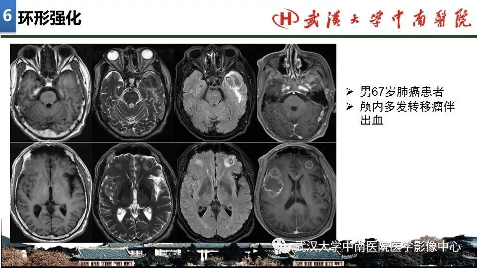 影像PPT - 【PPT】局灶性脑部病变影像诊断-41