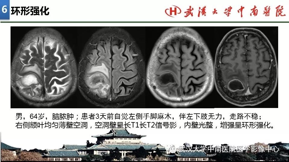 影像PPT - 【PPT】局灶性脑部病变影像诊断-42