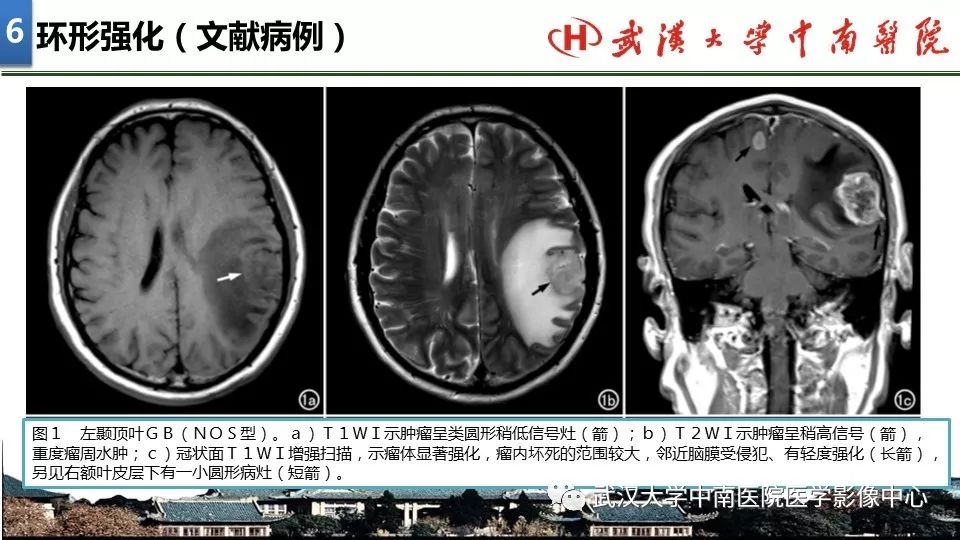 影像PPT - 【PPT】局灶性脑部病变影像诊断-43