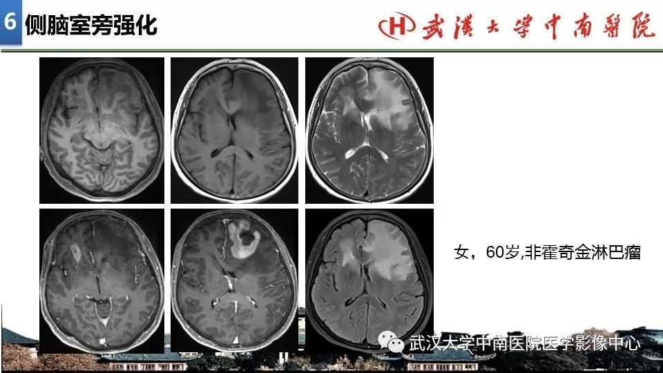 影像PPT - 【PPT】局灶性脑部病变影像诊断-47