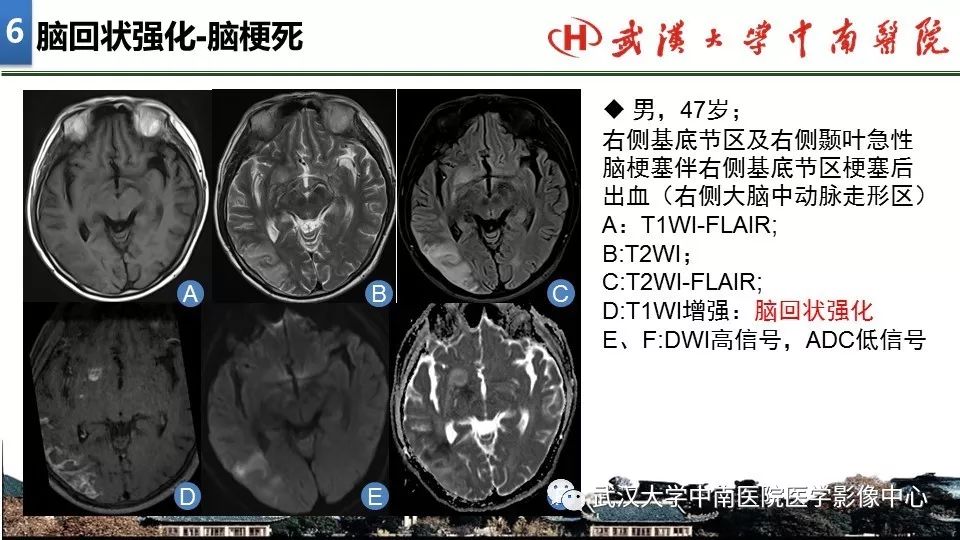 影像PPT - 【PPT】局灶性脑部病变影像诊断-45