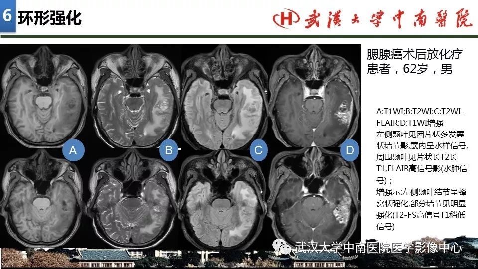 影像PPT - 【PPT】局灶性脑部病变影像诊断-44