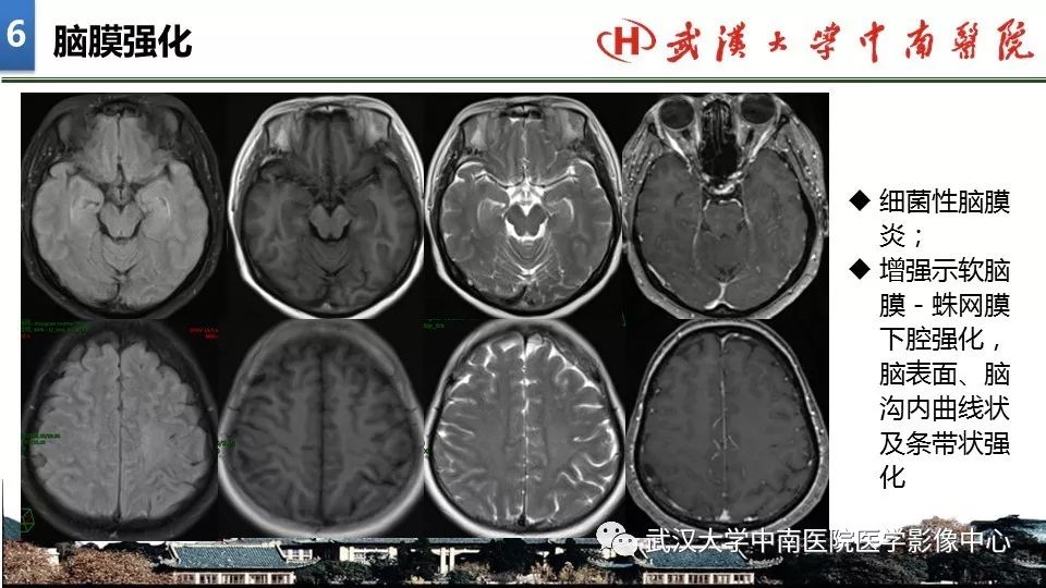 影像PPT - 【PPT】局灶性脑部病变影像诊断-46