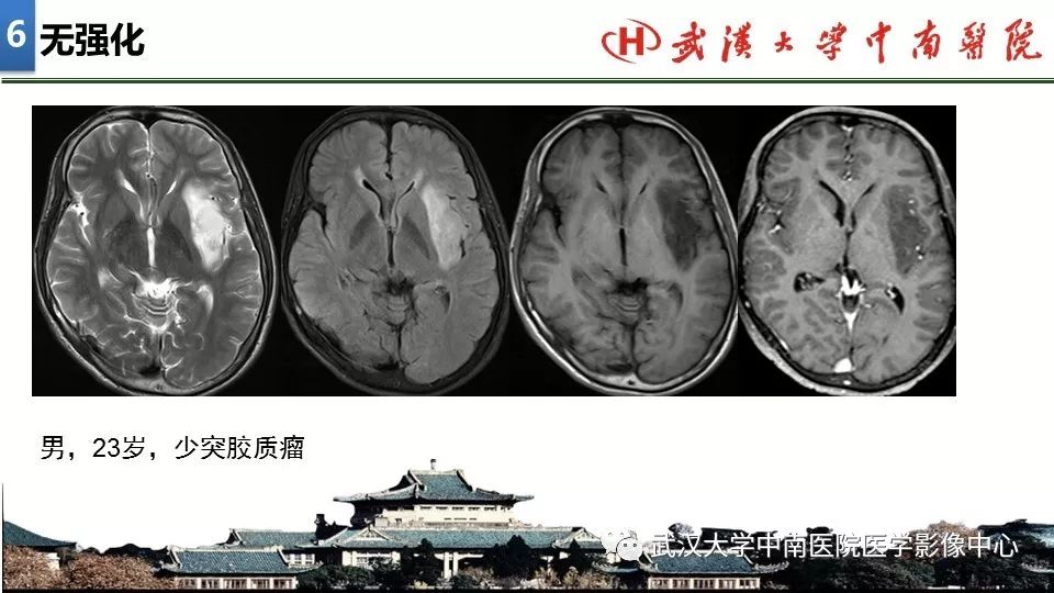 影像PPT - 【PPT】局灶性脑部病变影像诊断-49