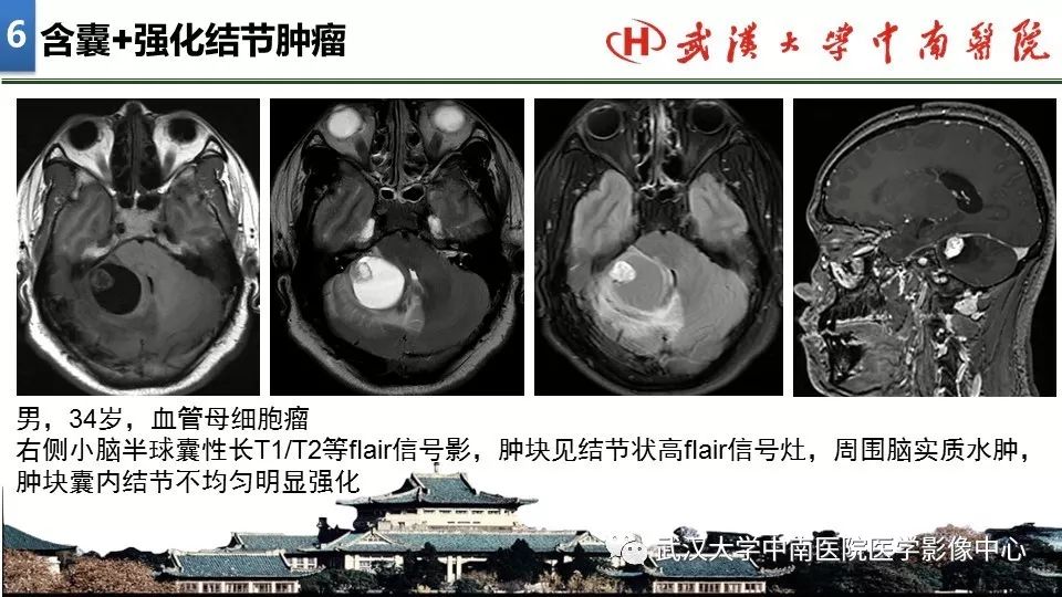 影像PPT - 【PPT】局灶性脑部病变影像诊断-50