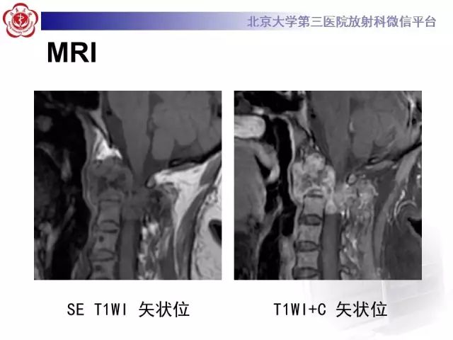 影像PPT - 【PPT】脊柱骨肉瘤-6