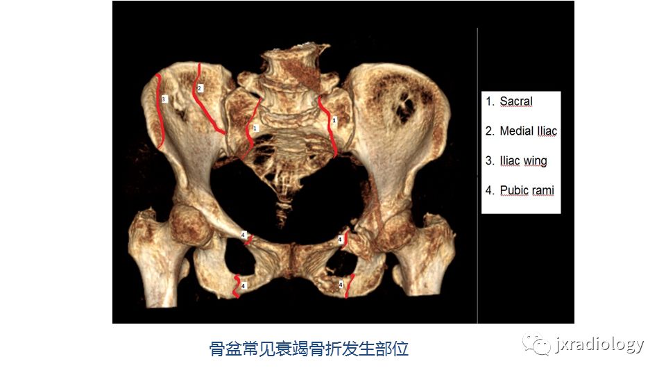 影像PPT - 【PPT】寻找骨折线：下肢应力性骨折的影像学检查-9