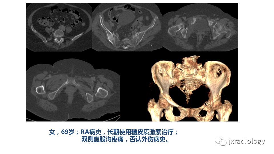 影像PPT - 【PPT】寻找骨折线：下肢应力性骨折的影像学检查-10