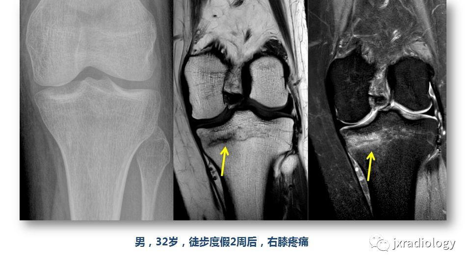 影像PPT - 【PPT】寻找骨折线：下肢应力性骨折的影像学检查-11