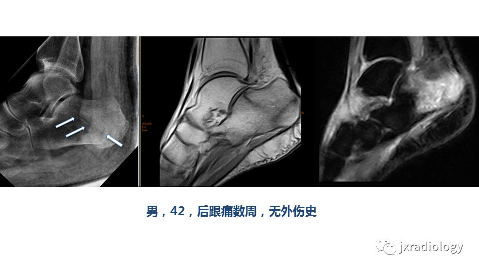 影像PPT - 【PPT】寻找骨折线：下肢应力性骨折的影像学检查-12