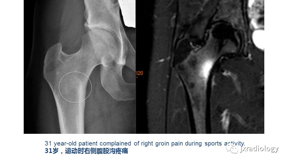 影像PPT - 【PPT】寻找骨折线：下肢应力性骨折的影像学检查-13