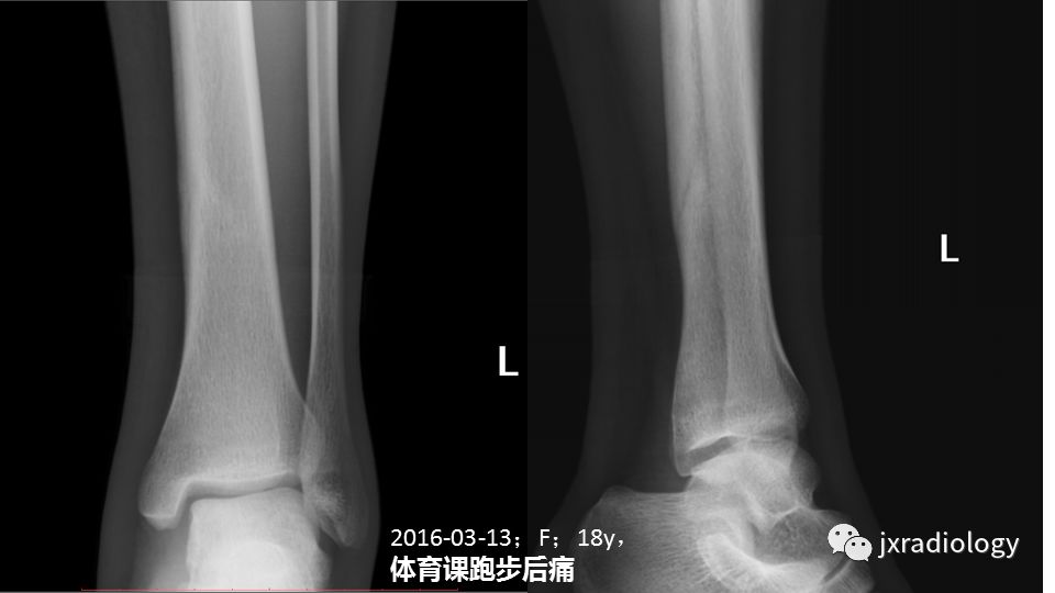 影像PPT - 【PPT】寻找骨折线：下肢应力性骨折的影像学检查-28