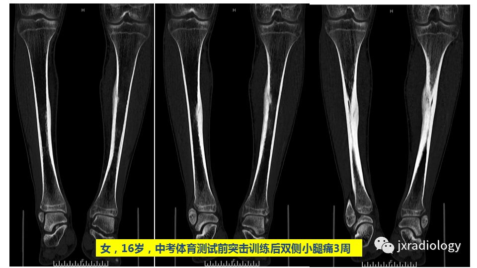 影像PPT - 【PPT】寻找骨折线：下肢应力性骨折的影像学检查-27