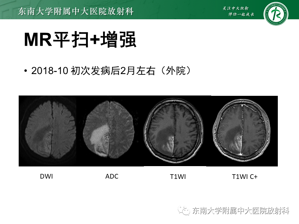 影像PPT - 【病例】原发性中枢神经系统血管炎(PACNS) VS 神经梅毒-9 影像PPT - 【病例】原发性中枢神经系统血管炎(PACNS) VS 神经梅毒-9