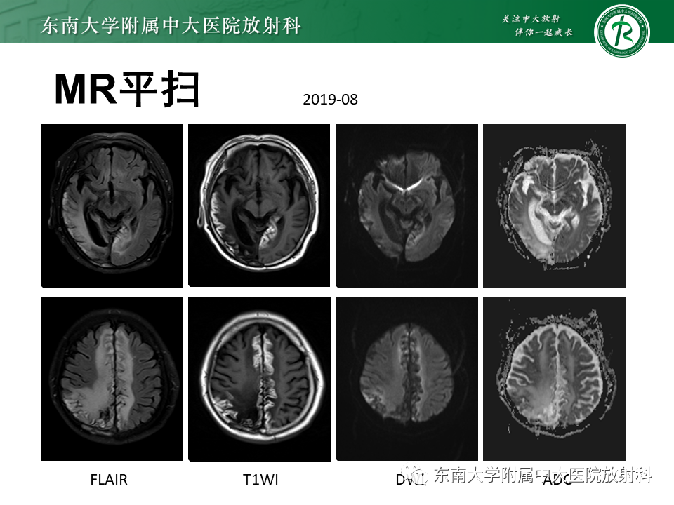 影像PPT - 【病例】原发性中枢神经系统血管炎(PACNS) VS 神经梅毒-10 影像PPT - 【病例】原发性中枢神经系统血管炎(PACNS) VS 神经梅毒-10