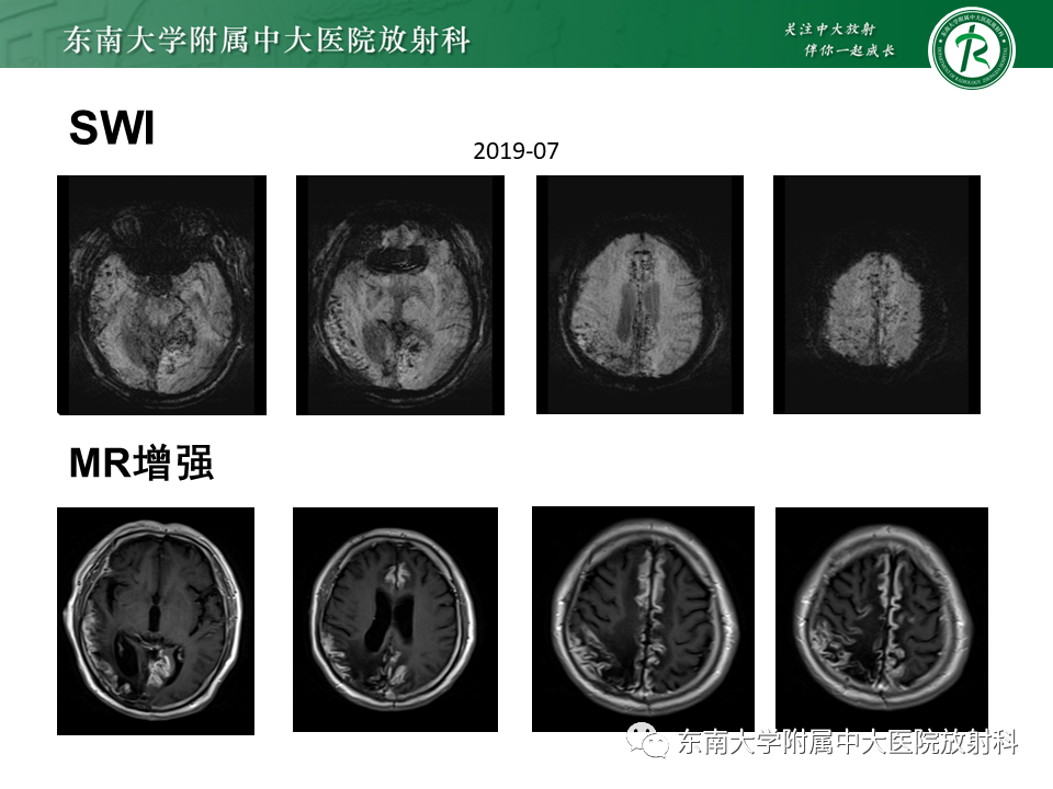 影像PPT - 【病例】原发性中枢神经系统血管炎(PACNS) VS 神经梅毒-11 影像PPT - 【病例】原发性中枢神经系统血管炎(PACNS) VS 神经梅毒-11
