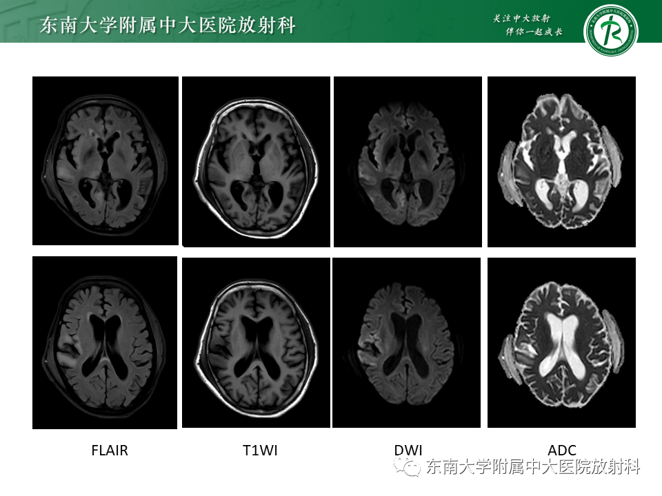 影像PPT - 【病例】原发性中枢神经系统血管炎(PACNS) VS 神经梅毒-15 影像PPT - 【病例】原发性中枢神经系统血管炎(PACNS) VS 神经梅毒-15
