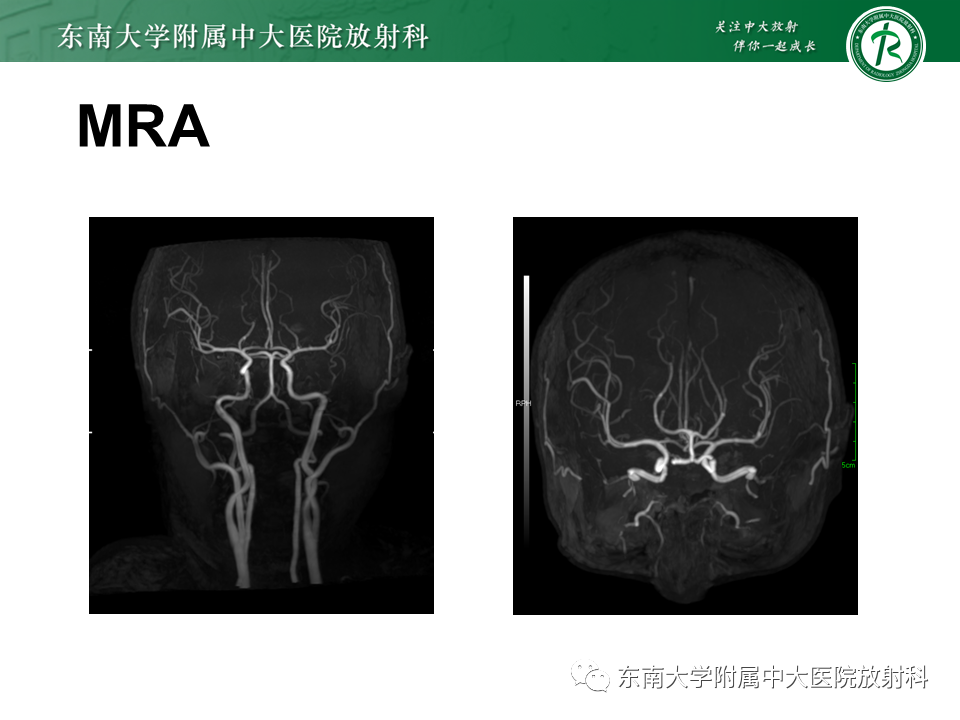 影像PPT - 【病例】原发性中枢神经系统血管炎(PACNS) VS 神经梅毒-16 影像PPT - 【病例】原发性中枢神经系统血管炎(PACNS) VS 神经梅毒-16