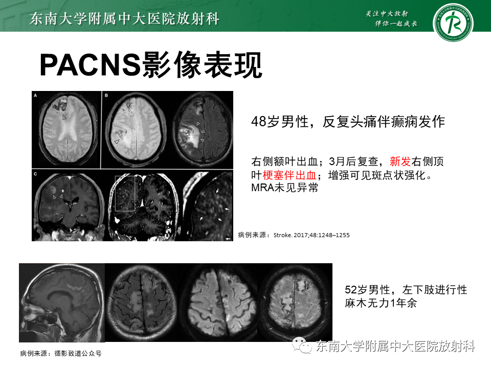 影像PPT - 【病例】原发性中枢神经系统血管炎(PACNS) VS 神经梅毒-24 影像PPT - 【病例】原发性中枢神经系统血管炎(PACNS) VS 神经梅毒-24