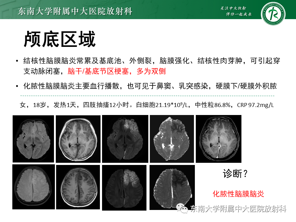 影像PPT - 【病例】原发性中枢神经系统血管炎(PACNS) VS 神经梅毒-30 影像PPT - 【病例】原发性中枢神经系统血管炎(PACNS) VS 神经梅毒-30