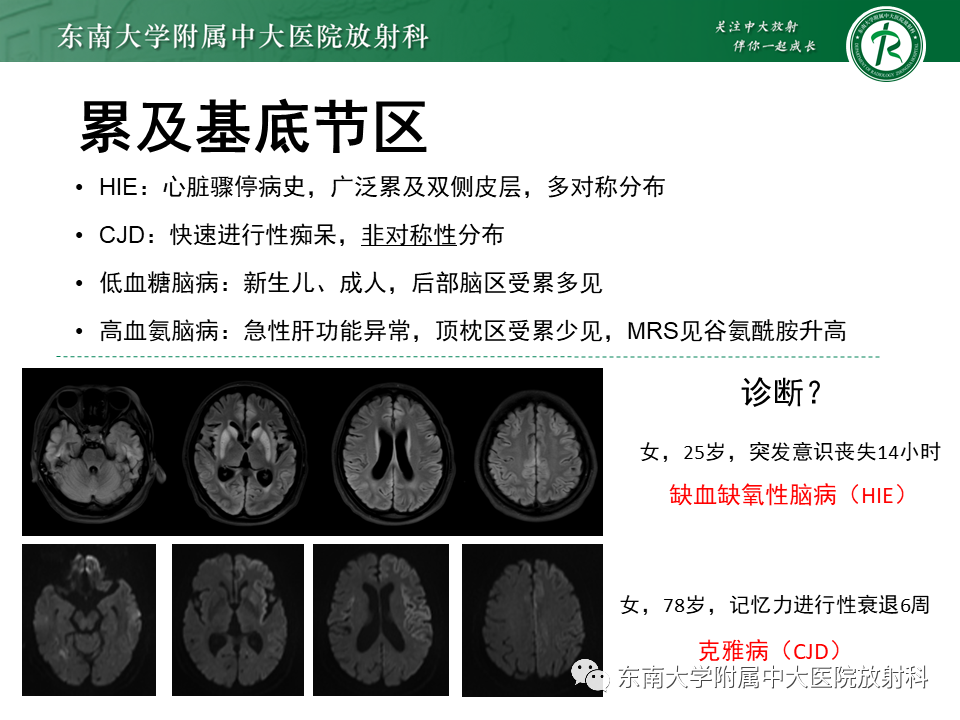 影像PPT - 【病例】原发性中枢神经系统血管炎(PACNS) VS 神经梅毒-33 影像PPT - 【病例】原发性中枢神经系统血管炎(PACNS) VS 神经梅毒-33