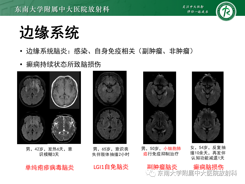 影像PPT - 【病例】原发性中枢神经系统血管炎(PACNS) VS 神经梅毒-31 影像PPT - 【病例】原发性中枢神经系统血管炎(PACNS) VS 神经梅毒-31