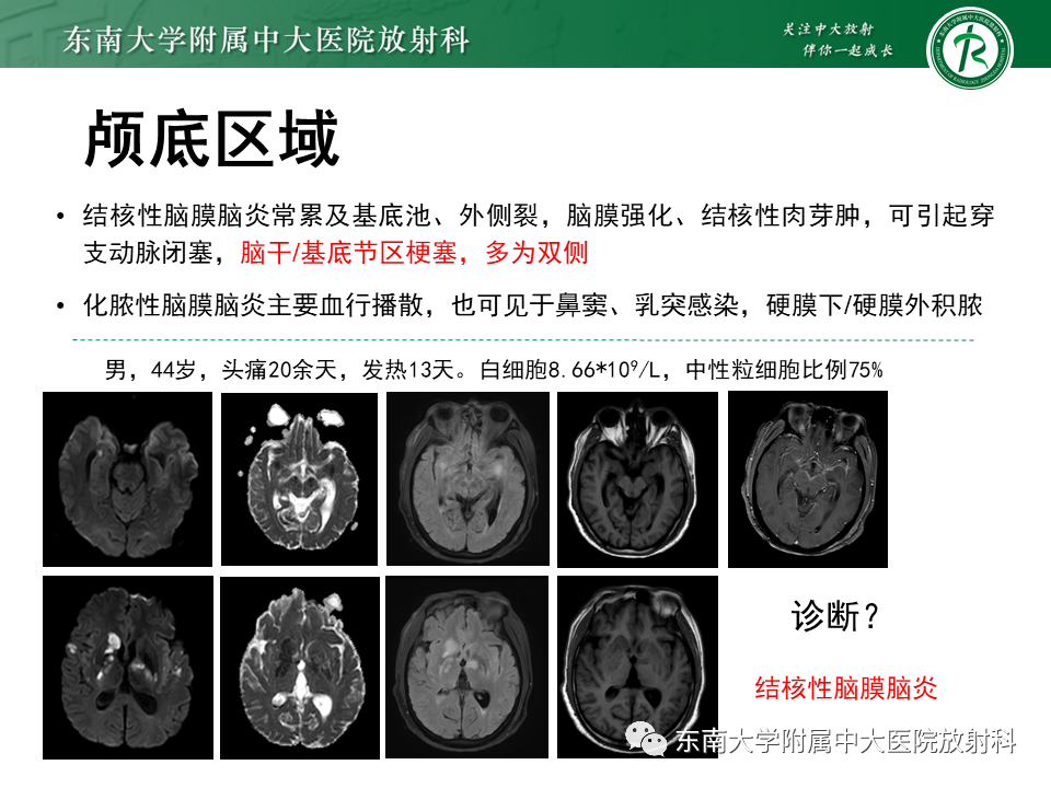 影像PPT - 【病例】原发性中枢神经系统血管炎(PACNS) VS 神经梅毒-29 影像PPT - 【病例】原发性中枢神经系统血管炎(PACNS) VS 神经梅毒-29