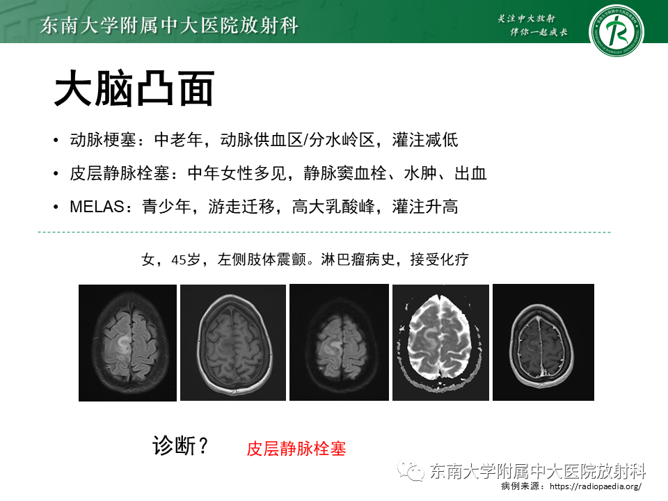 影像PPT - 【病例】原发性中枢神经系统血管炎(PACNS) VS 神经梅毒-32 影像PPT - 【病例】原发性中枢神经系统血管炎(PACNS) VS 神经梅毒-32