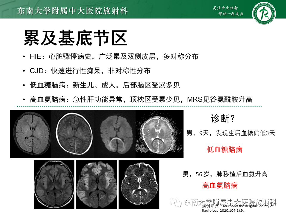 影像PPT - 【病例】原发性中枢神经系统血管炎(PACNS) VS 神经梅毒-34 影像PPT - 【病例】原发性中枢神经系统血管炎(PACNS) VS 神经梅毒-34
