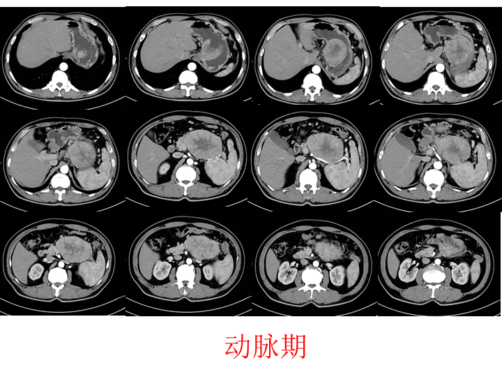 影像PPT - 【病例】胰腺腺泡细胞癌2例CT影像-4