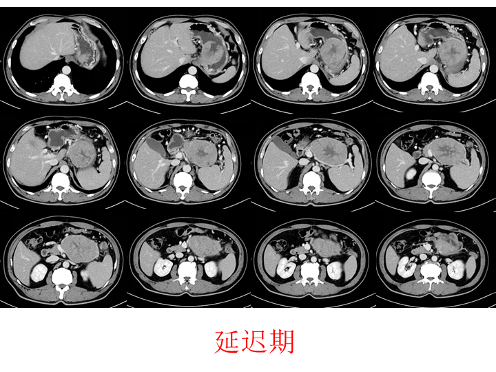 影像PPT - 【病例】胰腺腺泡细胞癌2例CT影像-6