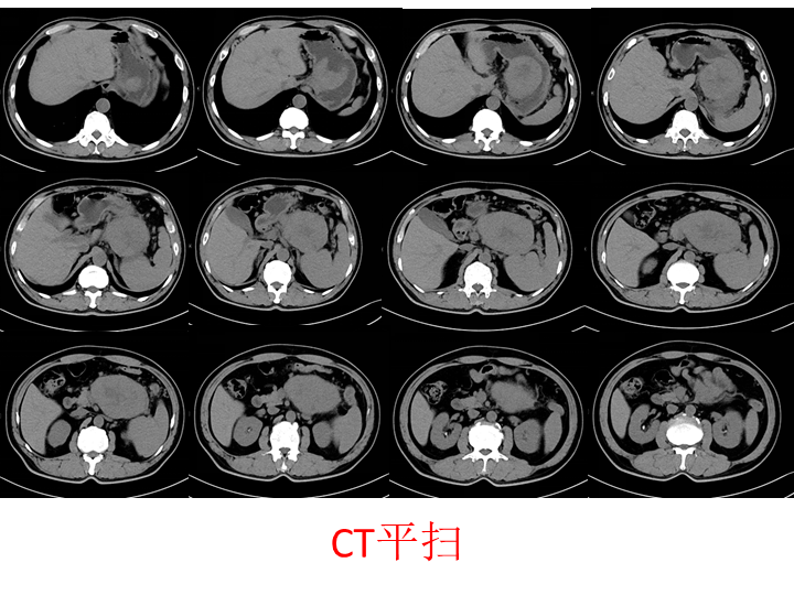 影像PPT - 【病例】胰腺腺泡细胞癌2例CT影像-3