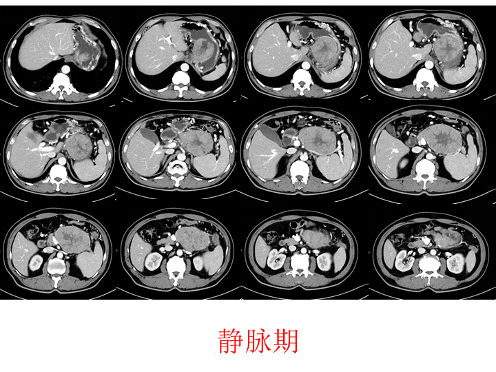 影像PPT - 【病例】胰腺腺泡细胞癌2例CT影像-5